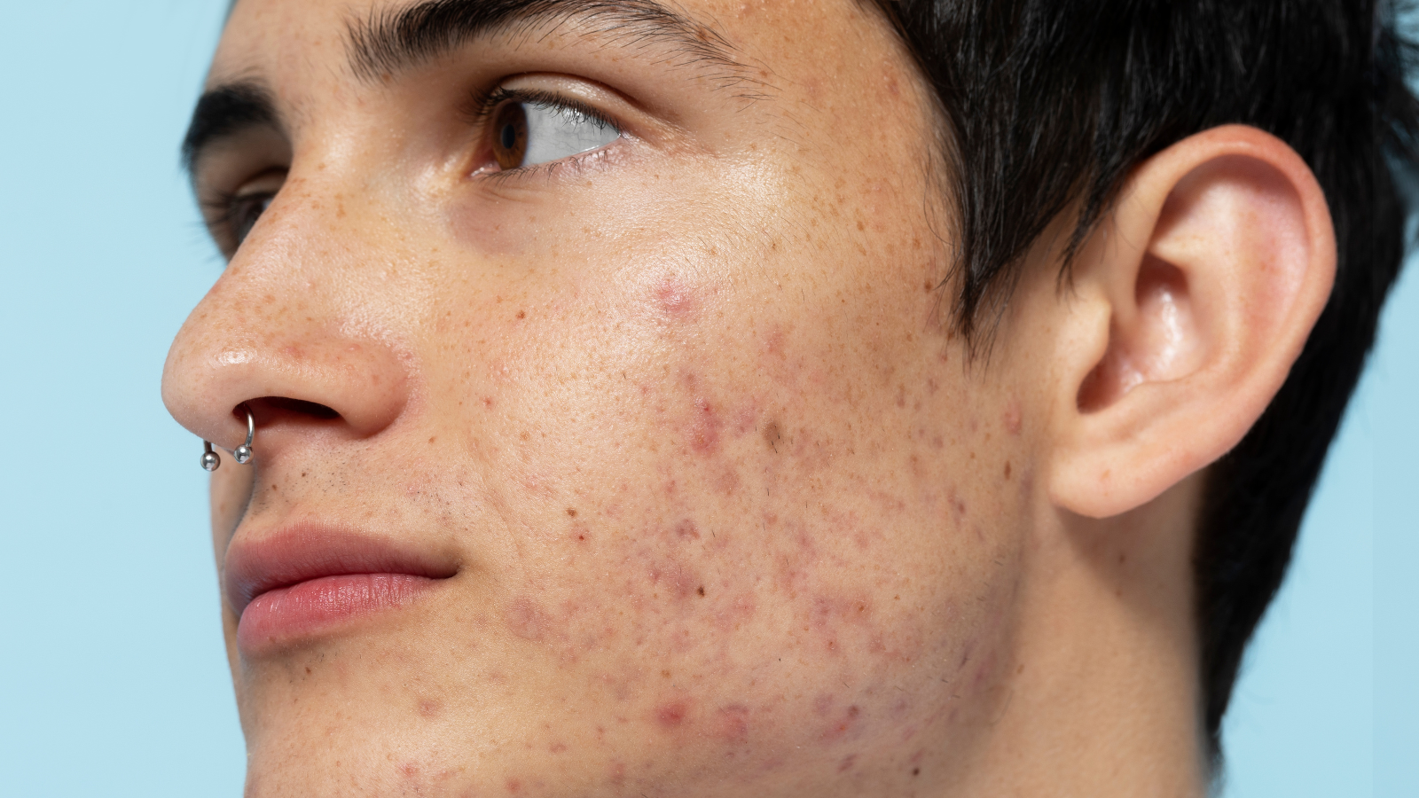 Rotina de skincare para acne