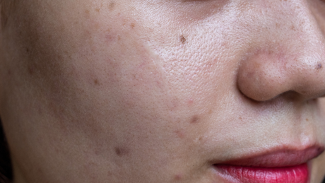 Como clarear manchas no rosto
