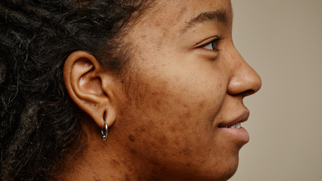 Como montar rotina de skincare para manchas?