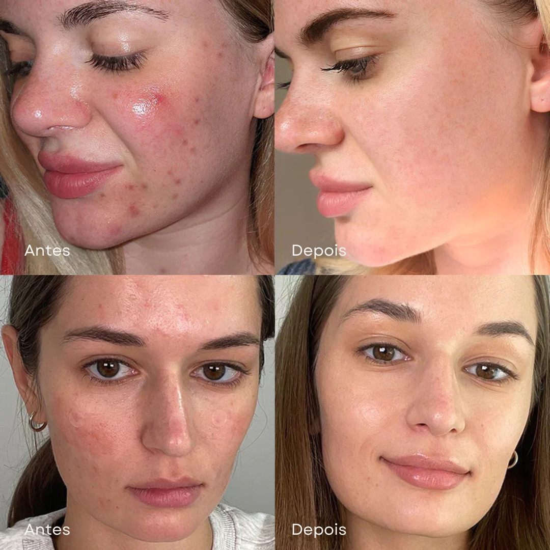 Sérum antiacne com niacinamida e succínico
